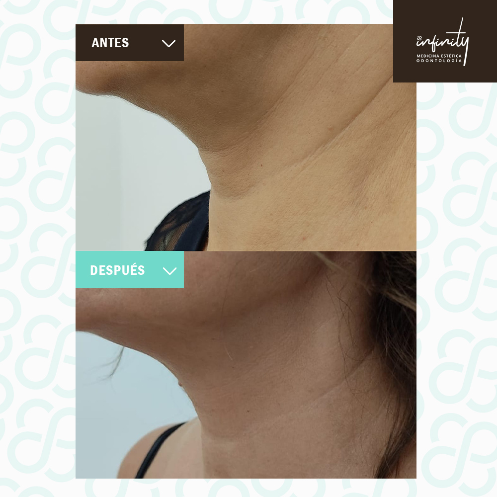 Cómo eliminar la papada